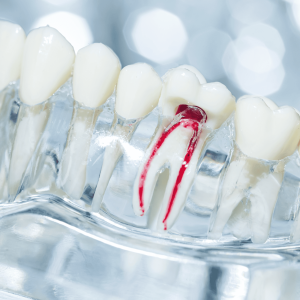 Root Canal Treatment